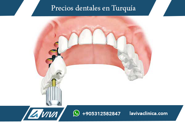 implantes dentales, precios implantes dentales, Turquía vs Tailandia, turismo dental, costos de implantes, odontología en Turquía, implantes dentales baratos, clínicas dentales en Turquía, comparación de precios dentales, salud bucal, mejores implantes dentales, carillas dentales, dentistas en Turquía, calidad dental, tratamientos dentales económicos