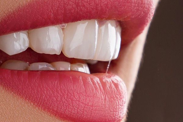 Carillas Dentales en Turquía