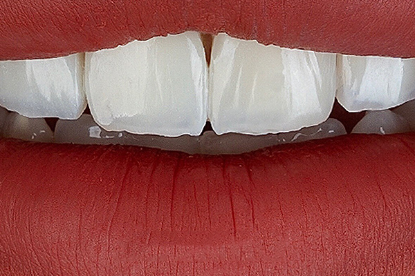 Carillas Dentales en Turquía