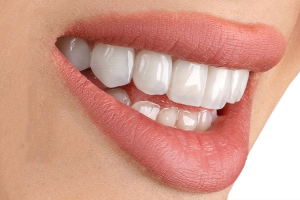 Carillas Dentales en Turquía