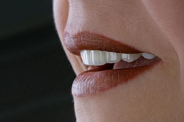 Carillas Dentales en Turquía