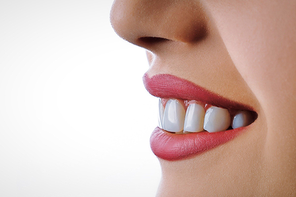 Carillas Dentales en Turquía