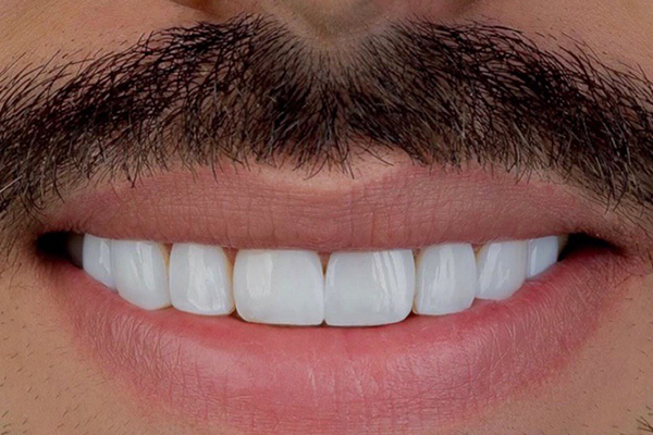 Carillas Dentales en Turquía