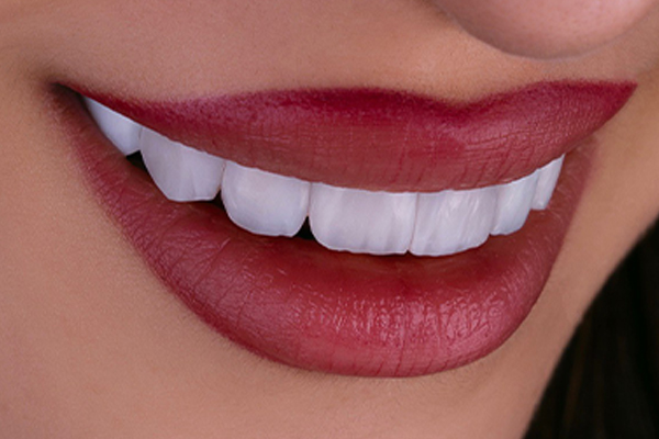 Carillas Dentales en Turquía: Transforma tu Sonrisa con Estética Dental de Vanguardia