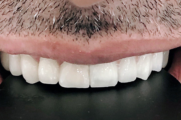 Carillas Dentales en Turquía