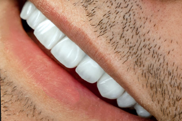 Carillas Dentales en Turquía