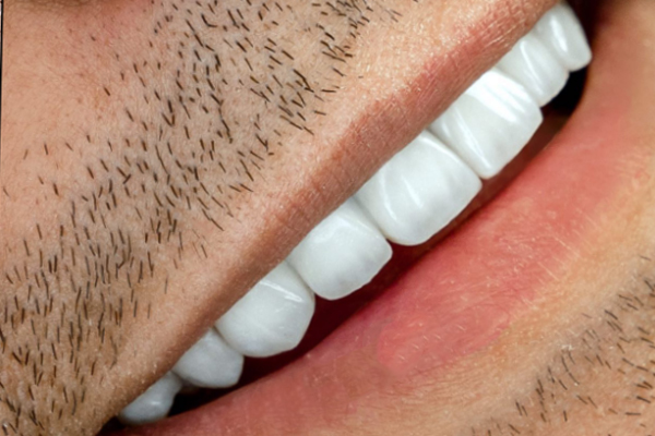 Carillas Dentales en Turquía
