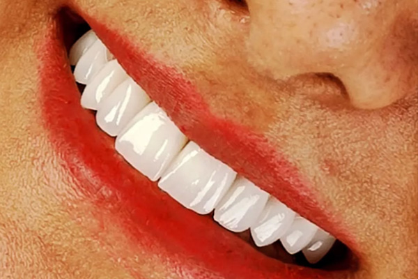Carillas Dentales en Turquía