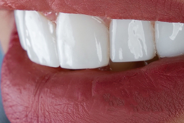Carillas Dentales en Turquía