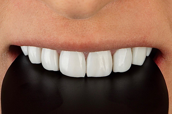 Carillas Dentales en Turquía