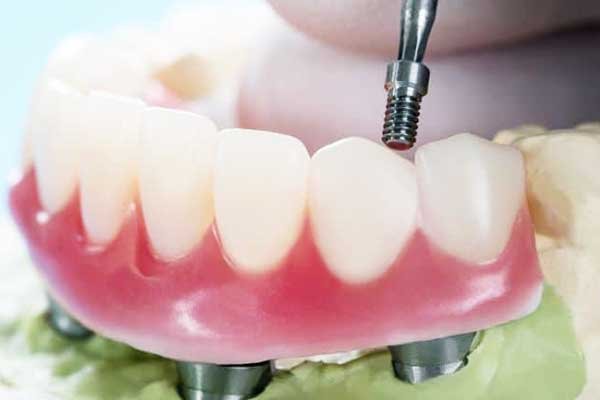 Fundas para dientes delanteros en La Viva Clinica Estambul