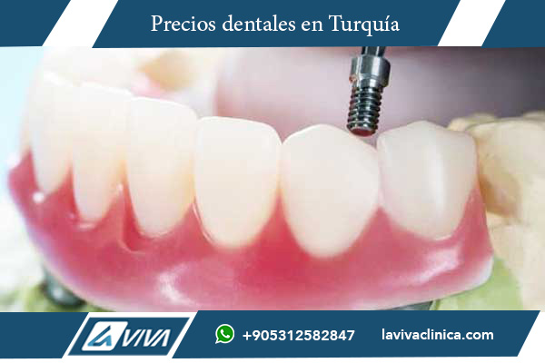 Precios de Carillas Dentales en Turquía