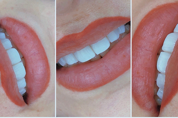 Carillas Dentales Precio Toda la Boca Turquía