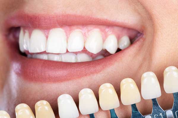 Facetas Dentárias na Turquia