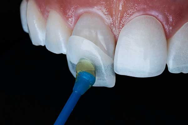 Facetas Dentárias Turquia