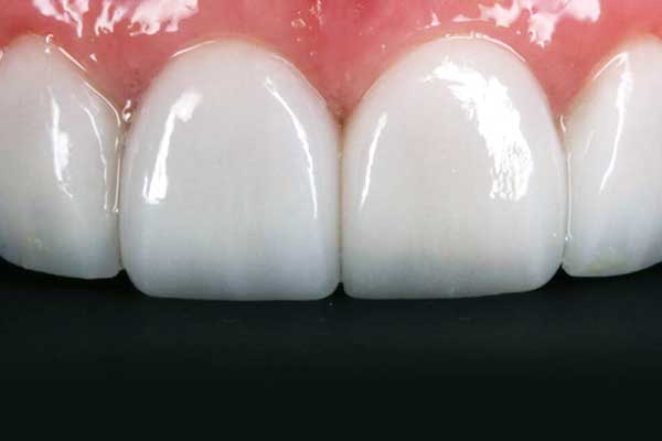 Facetas Dentárias Preço Turquia