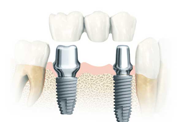 Implantes Dentários Turquia Fórum