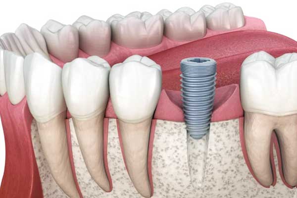 Implantes Dentários na Turquia