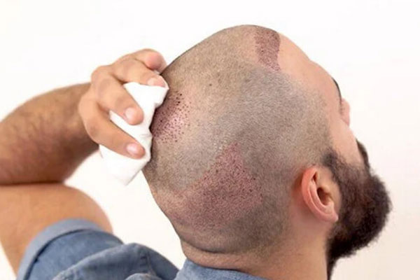 Implante Capilar Turquia