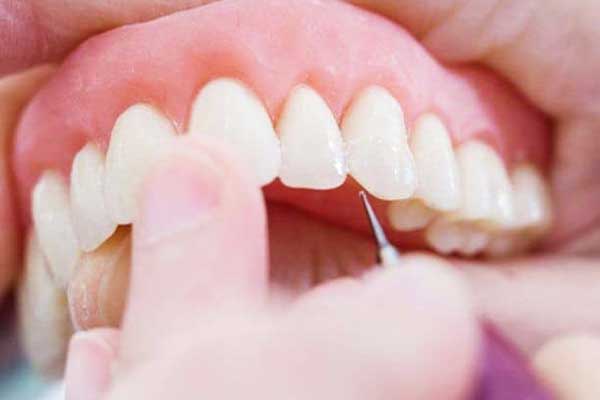 Coroas Dentárias Turquia