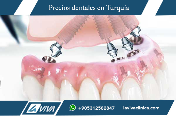implante dental boca completa